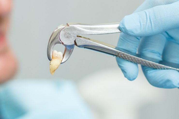 Tooth Extractions