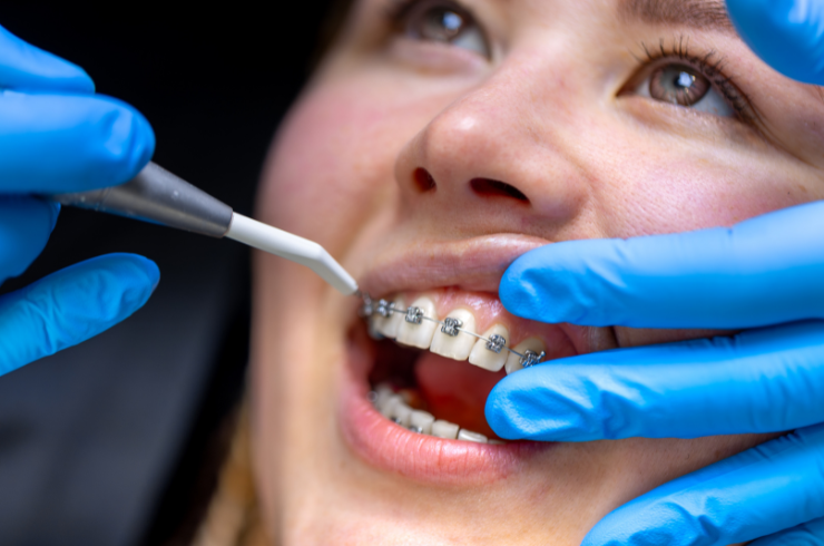 Metal & Ceramic Braces