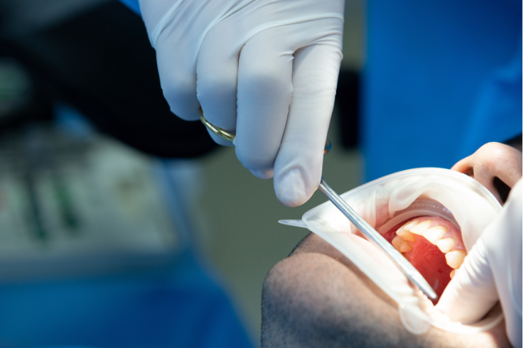 Dental Fillings