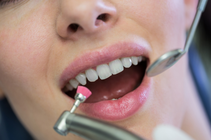 Professional Teeth Cleaning