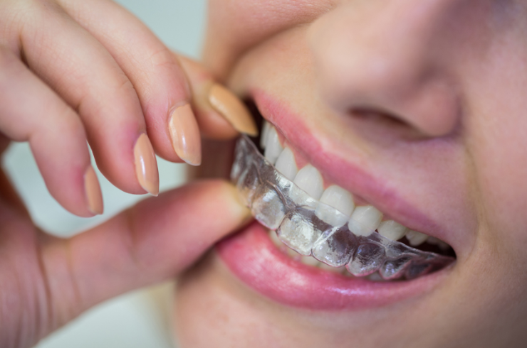Clear Aligners