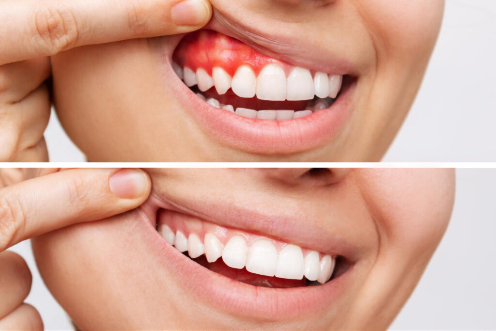 Gum Depigmentation