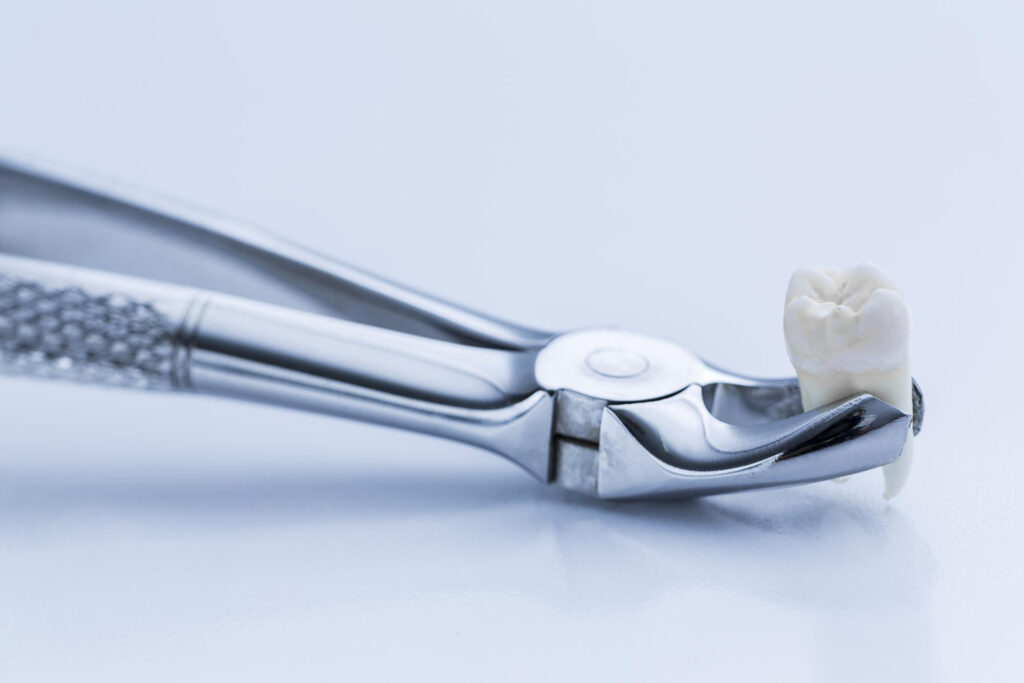 Tooth Removal