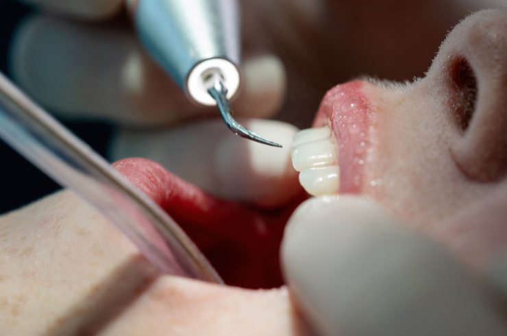 Professional Teeth Cleaning
