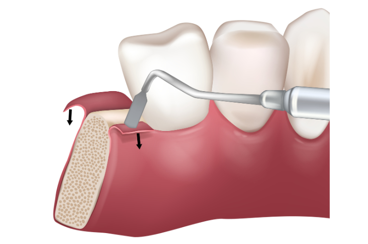 Conventional Flap Surgery