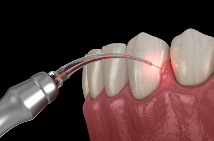 Laser Flap Surgery & Bone Grafting